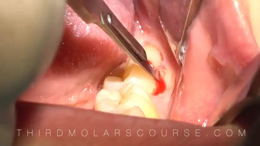 Still from the video: an impacted lower third molar being elevated, with the flap retracted and the surgical field in view