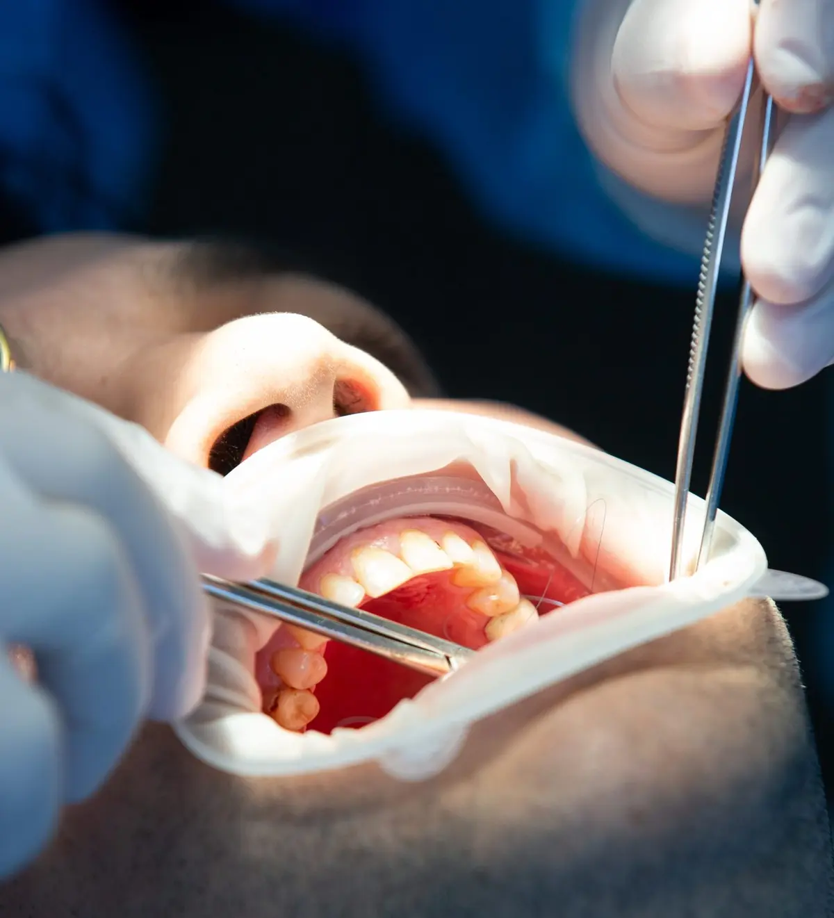 Close intraoral view through a white lip retractor: forceps and an elevator working on the lower right molars, with bleeding around the socket